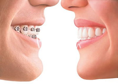 美式隐形正牙 美齿过程低调任性