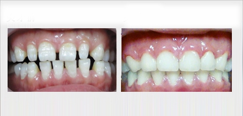牙齿稀疏怎么治疗更好