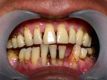 牙龈萎缩严重怎么治